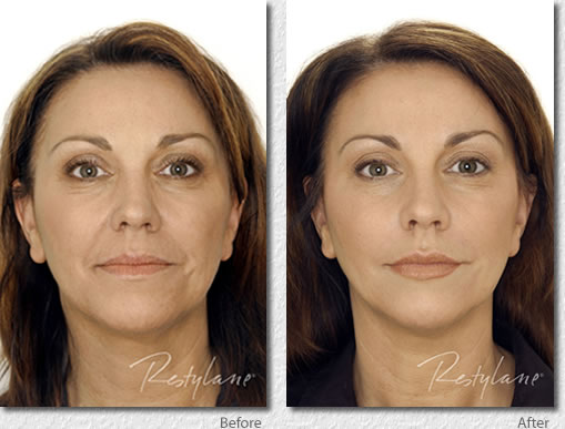 fillers before and after